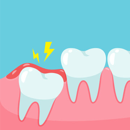 Wisdom Tooth Removal in RS Puram,Coimbatore